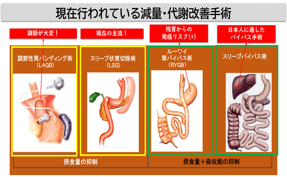 図：現在行われている減量・代謝改善手術